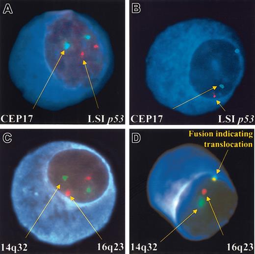 Figure 1. PCs with both the normal and abnormal pattern of hybridization. The depicted PCs show normal (A) and abnormal (B) patterns of hybridization. All panels show the blue fluorescence of the cytoplasm allowing the clone-specific interphase FISH scoring. (A) A cell with the normal configuration of 2 pairs of signals for the probes localizing to the centromere 17 (CEP17; green) and the 17p13.1 (LSI p53) (red) probe. (B) A cell with deletion of 17p13.1. There are 2 green signals arising from the centromeric probe but only 1 red signal from the p53 locus probe. (C) A normal configuration of probes used to detect the t(14;16)(q32;q23). The locus-specific 14q32 probes are labeled in green, and the 16q23 probes are labeled in red. (D) A cell with fusion of probes for 14q32 (green) and 16q23 (red). The 2 signals in proximity generate a fusion. If a significant number of cells scored showed this pattern, a patient is said to have a translocation.
