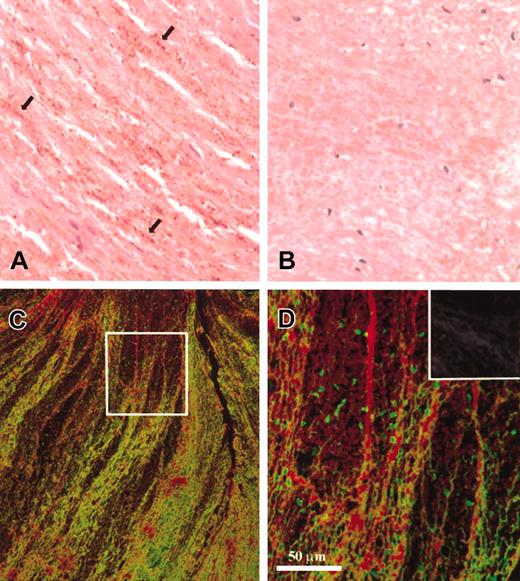 Figure 1. Myosin content of arterial thrombi. (A) The immunohistochemical detection of myosin (brown color) in a thrombus from human iliac artery (the reaction was carried out as described in “Materials and methods,” original magnification × 400). The antibody recognizes small dotlike deposits (arrows) running parallel with the erythrocytes. (B) Negative control, for which the primary antimyosin antibody has been preincubated with a 1000-fold molar excess of myosin (original magnification × 400). (C-D) Immunofluorescent confocal laser images of the same thrombus double-stained for myosin (green) and fibrin (red) as described in “Materials and methods.” The box in panel C indicates the area that is enlarged in panel D, whereas the inset in panel D shows a section not treated with antimyosin or antifibrin antibodies and inspected as indicated for this panel (autofluorescence). Original magnification × 20 for panel C and × 40 for panel D and its inset; the bar indicates the final magnification.
