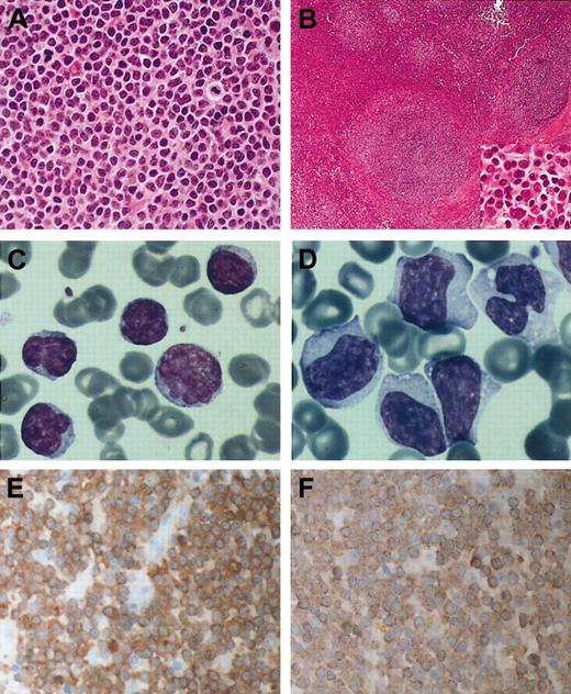 Figure 1. Histology, cytology, MALT1, and BCL10 expression in B-cell lymphomas with t(14;18)(q32;q21) involving MALT1 (A) Hematoxylin and eosin–stained section of case 1 showing typical centrocyte-like cells of MALT lymphoma. (B) Hematoxylin and eosin–stained splenic section of case 2; inset shows the morphology of tumor cells in the marginal zone. (C) Peripheral blood smear of case 2 at diagnosis. May-Grünewald-Giemsa stain. (D) Peripheral blood smear at transformation from case 2 shows blastic cells with abundant cytoplasm, irregular nuclei with nucleoli. May-Grünewald-Giemsa stain. (E) Immunohistochemstry for MALT1 in case 1 showing high levels of the protein in the cytoplasm of all tumor cells. Stained with hematoxylin. (F) Case no. 1 stained with BCL10 Mab 151 showing increased cytoplasmic BCL10 expression. Original magnifications: × 400 (A, B inset, E-F); × 100 (B); and × 1000 (C-D).