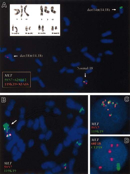 Figure 2. Cytogenetic and FISH analyses of patients with t(14;18)(q32;q21). (A) FISH study using flanking probes for MALT1 gene in peripheral blood cells from case 2. PACs 119K17 and 83A16 centromeric to MALT1 locus are shown in red; PACs 59N7 and 628B12, telomeric to MALT1 are shown in green. The pooled telomeric probes (green) hybridized to the derivative chromosome 14, whereas the pooled centromeric probes (red) hybridized to the derivative 18. A partial karyotype from case 1 including the t(14;18)(q32;q21) and the trisomy of chromosome 3 is shown in the top left corner. (B) In the SSK-41 cell line, selective amplification of MALT1 but not of BCL2 was observed. Cytogenetic analysis showed der(18)trp(18)(q11q21), which is marked with an arrow, as well as several insertions of chromosome material from 18q21 in different chromosomes. FISH analysis showed amplification of PAC 119K19 flanking 5′ region of MALT1 gene locus but not of PAC 59N7 located 3′ of MALT1, indicating that a chromosome break occurred before amplification. (C) Genomic amplification of MALT1 gene in KHM-10B cell line using MALT1 flanking probes. Eight copies of MALT1 were detected, confirming the array CGH data. (D) Genomic amplification of MALT1 in one case of gastric MALT lymphoma with bulky retroperitoneal disease at diagnosis. Five copies of MALT1 were seen.