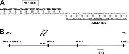 Figure 3. Location of the breakpoints within MALT1 and the IGH locus. (A) Sequence of the der(14)t(14;18)(q32;q21) breakpoint from case 1 (GenBank accession no. pending). Chromosome 18q21 sequences shown in bold, IGH sequences underlined, inserted nontemplated nucleotides in italics. DNA sequence analysis of cloned LDI-PCR product from case 1 showed loss of homology with IGH sequences beyond IGHJ5. The sequence beyond IGHJ5 was identical to sequence from BAC clone RP11-126O1, which contained not only both breakpoints but also the 5′ end of the MALT1 gene as well. (B) Ideogram to show the localization of chromosome 18q21 breakpoints. Both cloned breakpoints fell 5′ (centromeric) of the most 5′ exon of the database consensus MALT1 gene sequence (http://www.ncbi.nlm.nih.gov/entrez/viewer.fcgi?val=NP_006776.1). However, it should be noted that one report has indicated the presence of alternative 5′ MALT1 exons15; these are depicted as exons 1a and 1b. Neither of these exons is coding and therefore the open-reading frame of MALT1 is maintained in both translocations. Within the BAC clone RP11-126O1, the breakpoints were located at nucleotides 27 558 (case 1), and 28 209 (case 2), thus placing the breakpoints 1.1 and 1.7 kb upstream, respectively, of the first 5′ MALT1 exon.