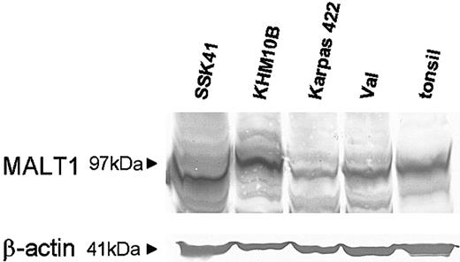 Figure 7. Western blotting analysis for MALT1 in cell lines with 18q amplification. Equal amounts of protein extracts from various cell lines and a tonsil were subjected to Western blotting analysis for MALT1. The protein is expressed at a much higher level in SSK-41 and KHM-10B that have MALT1 gene amplification, than in Karpas 422, VAL, and tonsil.