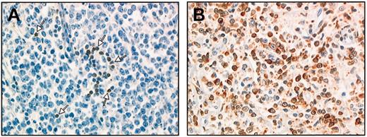 Figure 1. The bcl-2 staining patterns. The bcl-2 staining patterns for a nodal biopsy specimen (immunoperoxidase method and monoclonal antibody bcl-2). (A) A few positive T cells as positive control (arrows). Tumor cells × 537) are bcl-2–. (B) Almost all tumor cells × 537) are strongly positive for bcl-2 protein expression.