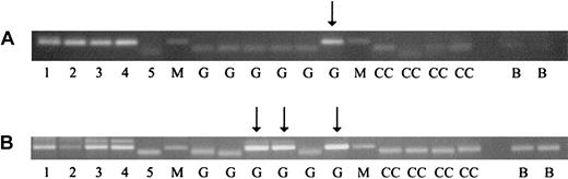 Figure 1. PCR analysis of clonotypic genomic inv(16) (CBFB-MYHII) and t(15;17) (PML-RARA) sequences in neonatal Guthrie cards of leukemic patients. For analysis of Guthrie cards, 1/16 pieces were placed directly in first-round PCR reactions (50 μL), and for each individual, we tested at least 8 such segments (1/2 of a 1.5-cm spot). Second-round amplification (25 μL) was performed with 1 μL from the first-round PCR reactions. PCR conditions included 2 preincubation steps of 80°C for 15 minutes and 94°C for 4 minutes, followed by 40 amplification cycles of 94°C for 30 seconds, 58°C for 1 minute, 72°C for 1 minute, and, finally, a 72°C extension step for 7 minutes. Results shown are from the second round of nested PCR analysis. Lane markers: M indicates molecular weight marker. Lanes 1-5 show 1:10 dilutions of patient diagnostic DNA with lane 1 being 10 ng/μL and lane 5, 1 pg/μL DNA. G indicates patient Guthrie card samples; CC, control Guthrie card samples (from a healthy nonaffected individual); B, blank (no DNA sample). Arrows indicate PCR products from patient Guthrie segments. (A) CBFB-MYHII case no. P5: a single patient Guthrie segment yielded a PCR product from 6 analyzed. (B) PML-RARA case no. P1: 3 patient Guthrie segments yielded positive PCR products from 6 analyzed.