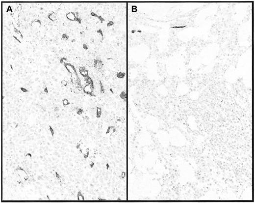Figure 1. Blood vessels before and after imatinib treatment. Blood vessels in patient no. 2 prior to (A) and after (B) 6 months on imatinib. After decalcification, paraffin-embedded sections were stained with anti-CD34 monoclonal antibody. Note also the marked reduction in cellularity. Magnification × 200.
