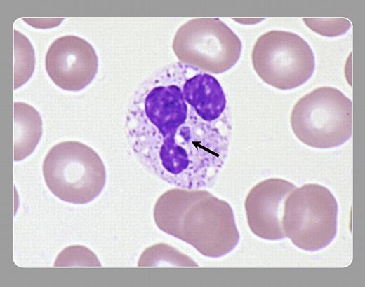 Peter Maslak and Lisa Southern, Memorial Sloan-Kettering Cancer Center