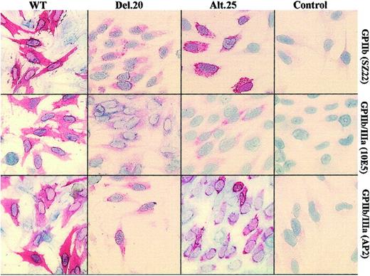 Figure 2. Immunostaining of transfected cells. WT BHK cells transfected with normal GPIIIa and GPIIb cDNAs displayed immunostainable GPIIb and GPIIb/IIIa detected with monoclonal antibodies against GPIIb (SZ22) and GPIIb/IIIa (10E5 and AP2). Cells containing GPIIb-del.20 exhibited faint staining with the 3 antibodies, and GPIIb-alt.25 cells exhibited more conspicuous staining with AP2 and SZ22 but not with 10E5. Control BHK cells were transfected with GPIIIa cDNA and pCEP4. Original magnification, × 200.