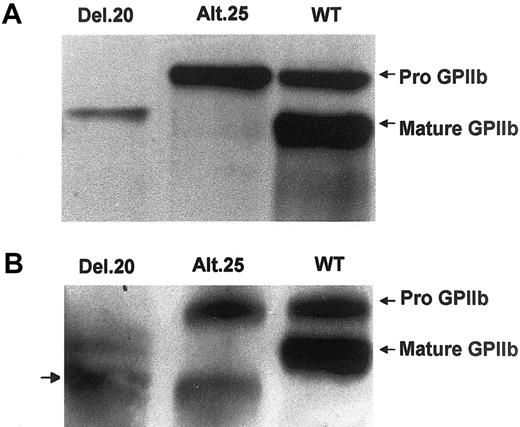 Figure 3. Identification of mutant GPIIb in cells expressing del.20 and alt.25. Shown are Western blots of immunoprecipitated GPIIb and GPIIIa from lysates of cells transfected with normal GPIIIa and normal or mutant GPIIb cDNAs. (A) Immunoprecipitation by polyclonal antibody against GPIIb and detection of GPIIb by SZ22 monoclonal antibody revealing both mature GPIIb and pro-GPIIb in WT cells, only pro-GPIIb in GPIIb-alt.25, and a fast-migrating pro-GPIIb in GPIIb-del.20. (B) Immunoprecipitation with CA3 monoclonal antibody against GPIIb followed by Western blot analysis with SZ22 revealing the same pattern as in panel A but an additional smaller band in the mutants probably representing a GPIIb degradation product.
