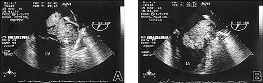 Figure 1. Transesophageal echocardiogram. (A) Left atrial intraluminal mass. (B) Atrial mass protruding into the left ventricle during diastole. LV indicates left ventricle.