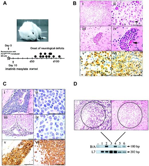 Figure 1. Clinical, pathological, and molecular characterization of Bcr/Abl-induced CNS leukemia. (A) A mouse with CML-like myeloproliferative disorder with right forelimb paresis and right ptosis that developed on imatinib mesylate therapy, and a timeline illustrating the onset of neurologic signs (•; N=11). (B) H&E–stained section of a parenchymal lesion in the cerebral cortex (i-ii) and a meningeal infiltrate in the Virchow Robin space (iii-iv; the associated blood vessel is shown at the large arrow) composed of cells with abundant cytoplasm and punctate nucleoli. Note occasional binucleated forms (ii, small arrow). Anti–Mac-3 IHC of the brain lesion (v) or a control section from the liver of a mouse with Bcr/Abl-induced macrophage leukemia (vi)1,2 confirms the cells are of the macrophage lineage. Scale bars are 50 μM. (C) A massive infiltration of the pyriform sinus (i-ii) and spinal cord meninges (iii-iv) by a homogeneous population of medium-sized cells with scant cytoplasm and indistinct nucleoli. Anti–B-lymphoid cell antibody (CD45R/B220) staining of the pyriform mass (v) and control normal mouse spleen (vi) confirms the B-lymphoid cell lineage. Scale bars are 50 μM. (D) A laser-dissected brain lesion (right photomicrograph; lane 4) and an adjacent area of normal brain (acumbens) composed of small neurons (left photomicrograph; lane 3) were analyzed by PCR using primers specific for the P210BCR/ABL cDNA junction (B/A, top blot). For comparison, a section from the liver of a mouse with macrophage leukemia (lane 6) or normal liver (lane 5) was processed in the same fashion. 32D cells expressing P210 Bcr/Abl (lane 2) or neomycin alone (lane 1), or water only (–), were amplified using the same primers. To control for equivalent specimen quality, samples were also analyzed using primers detecting expression of the ribosomal-associated gene L7. Sizes of the PCR products are shown at right. The results depicted were confirmed in 3 additional PCR experiments from 2 independent sets of tissue dissections. Original magnification, × 10.