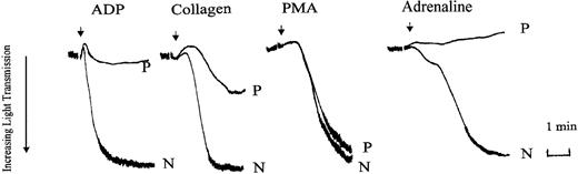 Figure 1. Agonist-induced platelet aggregation in PRP prepared from normal (N) or patient (P) blood. Platelet aggregation was measured in an aggregometer (dual channel from Chrono-Log) and aggregation was indicated by an increase in light transmittance. Aggregation responses to ADP (10 μM), collagen (2 μg/mL), PMA (100 nM), and adrenaline (5 μM) were examined. The tracings shown are from an experiment representative of 3 others with essentially similar results. Arrows indicate points of agonist addition.