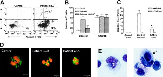 Figure 1. Granulocytes from GSD1b patients display apoptotic features. (A) Freshly purified neutrophils from a patient with GSD1b (n = 5) and an age-matched control (n = 10) were stained by Annexin-V–fluorescein isothiocyanate (FITC) and PI, and analyzed by FACScan. Representative dot plots are shown. Values indicate the proportion of Annexin-V+ cells. (B) The summarized data of all measurements performed in fresh cells and cells cultured overnight in the absence or presence of exogenous G-CSF (100 ng/mL; n = 5). Bars represent mean ± SD of Annexin-V+ cells in percentage of total number of neutrophils. (C) Overall caspase proteolytic activity in cell lysates prepared from 0.5 × 106 fresh healthy control neutrophils and neutrophils cultured overnight (∼ 70% apoptotic cells as measured by Annexin-V–FITC staining and morphologic examination; n = 5) as well as from freshly isolated neutrophils of 3 GSD1b patients was measured by cleavage of the fluorogenic caspase substrate DEVD-AMC. To check the specificity of the caspase proteolytic activity, the general caspase inhibitor zVAD-fmk (10 μM final concentration; Alexis Biochemicals) was added to the assay mixture. The maximum speed (maximal slope) of AMC release was used as a measure of caspase activity. Results are presented as mean ± SD maximal slope. *P < .01 (by Student t test) versus control fresh neutrophils. RFU indicates relative fluorescence units. (D) Fresh neutrophils from a healthy control and from patients with GSD1b were stained with antibody specific for Bax (green), counterstained with PI (1 μg/mL; red) to visualize nuclear morphology, and analyzed by confocal microscopy. Note that in the control image a punctate-dispersed distribution of Bax and polysegmented nucleus with normal chromatin are present. In contrast, both patients' images (nos. 3 and 5) reveal Bax clustering and typical apoptotic nuclei with condensed chromatin (for further comparison with normal neutrophils, see also Maianski et al17). Representative images from 5 controls and 5 GSD1b patients are shown. Bar is 5 μm. (E) Whole leukocyte preparation from patients with GSD1b (1.5-2 × 105 cells) was obtained after erythrocyte lysis. Cytospins stained with Giemsa solution were analyzed by light microscopy. Engulfment of apoptotic material (left panel) and intact cellular remnant (arrow, right panel) in monocytes are shown. Original magnification, × 400.