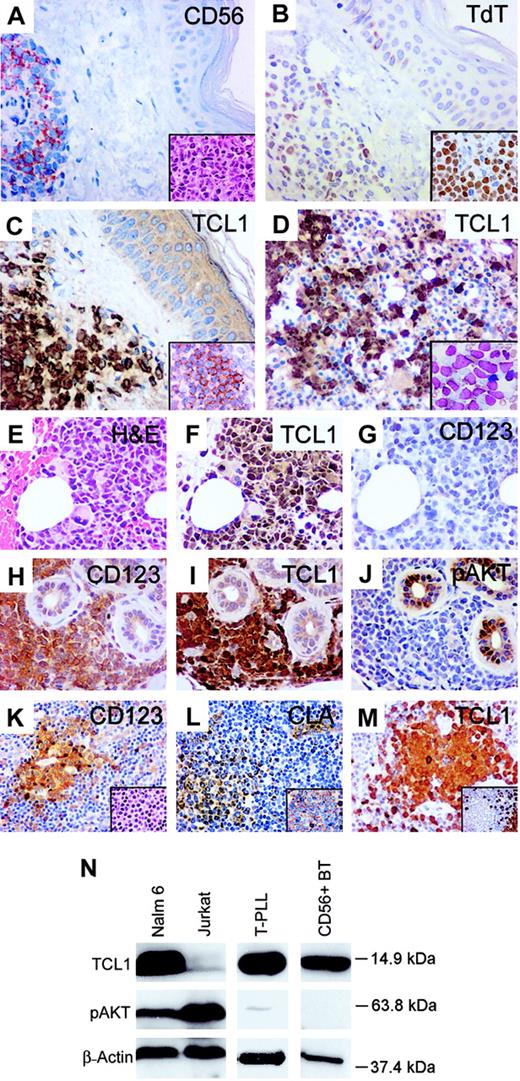 Figure 1. Comparison of immunophenotype of CD4+ CD56+ blastic tumors and plasmacytoid dendritic cells. (A-G) A case of CD4+ CD56+ BT presenting in skin and lymph node that transformed into monocytic AML at 22 months. Tumor cells in skin show uniform expression of CD56 (A), with a lymphoid morphology (inset). Variable TdT expression was seen in the skin tumor (B), with stronger TdT expression seen in tumor cells from an involved lymph node (inset). Tumor cells in skin show strong nuclear and cytoplasmic staining for TCL1 (C) and CD123 (inset), with marrow tumor cells (D inset; Wright-Giemsa stained smear) also positive for TCL1 (D). Bone marrow blasts in the subsequent myelomonocytic leukemic transformation (E) also show strong TCL1 immunostaining (F) but were negative for CD123 (G). (H-J) Another CD4+ CD56+ BT of skin with strong CD123 (H) and TCL1 expression (I) but absence of pAKT immunostaining (J). (K-M) Plasmacytoid dendritic cells (DC2s) in a reactive lymph node (inset K) stain for CD123 (K), CLA (L), CD45RA (inset L), and TCL1 (M) and are negative for CD20 (inset M). (N) Western blot analysis with TCL1 antiserum detects a 14-kDa protein in a B-lymphoblastic cell line (NALM-6), T-PLL carrying a chromosome14 inversion, and tumor cells from a case of CD4+ CD56+ BT. The latter case demonstrated strong immunostaining for TCL1 (I) and absence of pAKT-Ser473 expression (J), both of which were confirmed by Western blot analysis (N). Original magnifications, × 400; insets, × 1000.