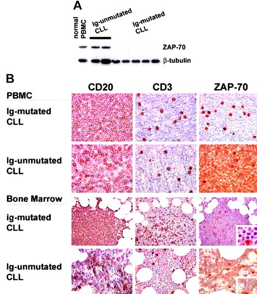 Figure 6. ZAP-70 protein expression can distinguish CLL subtypes. (A) ZAP-70 protein expression was assessed by Western blotting in whole cell lysates of normal PBMCs, or CD19+-purified leukemic cells from blood of patients with Ig-unmutated and Ig-mutated CLL. The data are representative of Western blot analysis of 60 patient samples analyzed. Equal loading is demonstrated by probing for β-tubulin. (B) ZAP-70 can be detected by immunohistochemistry in clinical samples. PBMCs (top 2 rows; original magnification, × 200) were embedded in a fibrin clot, fixed, and processed by standard techniques. PBMCs and routine bone marrow trephine biopsies (bottom 2 rows; original magnification, × 100-200) were stained with CD20, demonstrating involvement by B-CLL, and CD3, which stains interspersed T cells. Insets show areas of the respective sample at an original magnification of × 1000. ZAP-70 was positive in T cells and Ig-unmutated CLL cells.