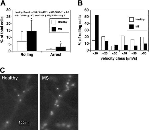 Figure 3. CD8+ lymphocytes from patients with acute MS display increased rolling and sticking in brain venules. CD8+ cells were isolated from 4 patients and 4 healthy controls. Experiments were performed in 4 mice. Seven venules were examined. (A) Rolling and arrest fractions were compared between healthy controls (□) and patients with acute MS (▪). Mean ± SD are presented. *P < .04. (B) Velocity histograms were generated as described in the legend to Figure 1B. Fifty-nine rolling cells were examined from healthy donors (□), and 64 rolling cells were considered from patients with acute MS (▪). (C) Adherent CD8+ T cells obtained from a healthy donor (Healthy) (CMFDA-labeled) and a patient with acute MS (MS) (CMTMR-labeled) in the same cerebral venule. Note the difference in the number of adherent cells between the 2 populations.