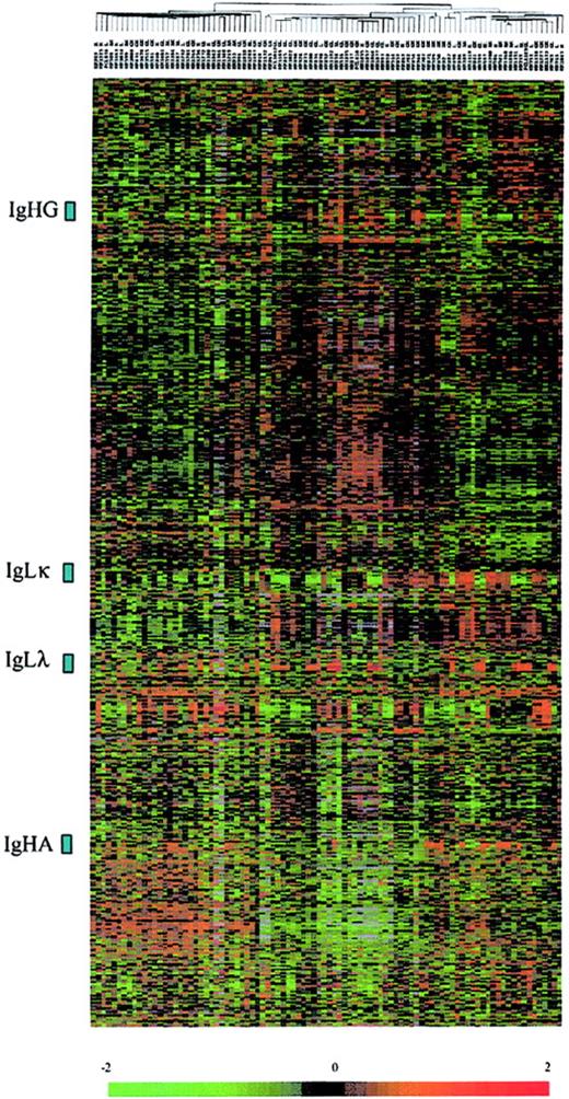 Figure 1. Hierarchic clustering of 92 diagnostic MM and PCL samples (columns) versus 2600 genes (rows). The normalized expression value for each gene is depicted according to the scale at the bottom; red indicates expression levels greater than the median, and green indicates levels less than the median (–2 to 2 in log base 2 units). Gray indicates excluded values.