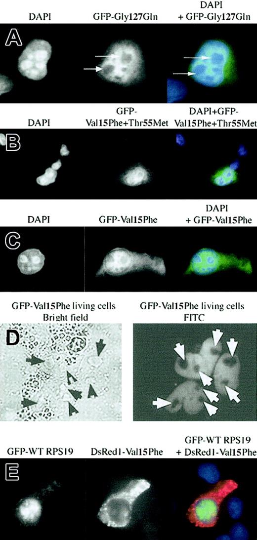 Figure 4. Altered subcellular localization of mutant RPS19 characterized in 2 DBA patients. A DBA patient carried the mutation Gly127Gln located in the C-terminal NoS, and another one carried a double missense mutation, Val15Phe + Thr55Met, in which the Val15Phe was located in the first NoS defined in this study. In each panel (A-C, E) the left field shows DAPI nuclear staining, the middle field shows FITC staining of the GFP-RPS19 fusion proteins, and the right field shows merged fields of DAPI + FITC staining. We analyzed the subcellular distribution of RPS19 after transfection of Cos-7 cells with either a GFP-mutated Gly127Gln (panel A), Val15Phe + Thr55Met (panel B), or Val15Phe (panel C) RPS19. Each DBA mutant: Gly127Gln and Val15Phe + Thr55Met impaired RPS19 nucleolar import (panels A-B). In the double mutant, the missense mutation Val15Phe is solely responsible for the impairment of RPS19 nucleolar import since Val15Phe RPS19 failed to localize to the nucleoli (panel C), while Thr55Met RPS19 exhibited normal nucleolar localization (data not shown). Arrows indicate the absence of RPS19 nucleolar staining in the Cos-7 cell shown. (D) In order to rule out a putative effect of the fixation with chilled methanol, RPS19 subcellular distribution was investigated in live transfected cells. The left panel depicts the bright field illumination, and the right panel shows the fluorescent GFP-RPS19 fusion protein. Arrows mark RPS19 nucleolar localization. (E) Green fluorescent fusion protein GFP-WT RPS19 (left panel, FITC staining) and the red fluorescent fusion protein DsRed1-mutated Val15Phe RPS19 (middle panel, Texas red staining) were coexpressed in transfected Cos-7 cells. Normal RPS19 was localized to the nucleoli, while mutant Val15Phe (red) was not imported into the nucleoli (right panel, DAPI + FITC + Texas red staining). Original magnifications: × 63 (A-C,E); × 40 (D).