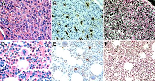 Figure 2. Bone marrow biopsy findings in representative HES patients. Biopsy sections from patients with HES with (A-C) and without (D-F) elevated serum tryptase levels were stained with hematoxylin and eosin (A,D), antitryptase antibody (B,E), and antireticulin antibody (C,F). Although the bone marrow biopsy specimens from both patients show a dramatic increase in eosinophils and myeloid precursors (A,D), only the specimen from the patient with elevated serum tryptase shows marked hypercellularity (A), atypical spindle-shaped mast cells (B), and reticulin fibrosis (C).