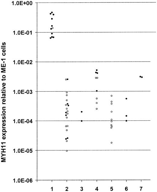 Figure 1. MYH11 overexpression in CBFB-MYH11– positive cells. The expression in CBFB-MYH11–positive ME-1 cells was set at 1.0. From all cases informed consent was obtained in accordance with the Declaration of Helsinki. The numbers indicate the following: (1) newly diagnosed CBFB-MYH11–positive AML (n = 11); (2) newly diagnosed CBFB-MYH11–negative AML (n = 21); (3) CBFB-MYH11–positive cases in complete hematologic remission (n = 2); (4) de novo chronic myeloid leukemia (n = 9); (5) history of chronic myeloid leukemia (n = 10); (6) de novo acute lymphocytic leukemia (n = 3); and (7) healthy volunteers (n = 2). ○ and • indicate blood and bone marrow samples, respectively. Primers and probes were developed downstream of all known MYH11 fusion points using Primer Express version 1.5 (Applied Biosystems, Foster City, CA). Sequences (5′-3′) of MYH11 forward and reverse primers and probe are respectively, AGTAGCCTGTCGGGAAGGAAC, GCCTGCTGTGTGGCTTTG, CACTCCAGGACGAGAAGCGCCG. The cDNA synthesis and input, cycling conditions, and PBGD expression measured for normalization were as described.9 For quantification, serial log dilutions of cDNA in H2O derived from the CBFB-MYH11–positive cell line ME-1 were used. Linear amplification extended down to a 4 log dilution.