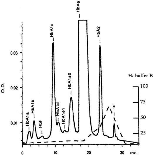 Fig. 1. HPLC chromatogram of hemoglobin components. / Elution profile OD (—); percentage buffer (- - -).