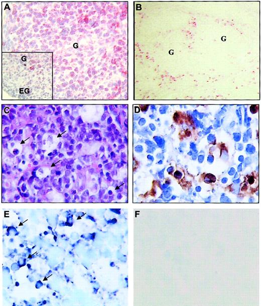 Fig. 11. GILZ gene expression in DTH reactions and in Burkitt lymphomas. / RANTES (A) and GILZ (B,E) gene expression was analyzed by in situ hybridization with an antisense probe in patients with DTH reactions (A-B) and in Burkitt lymphomas (E). No labeling was observed with the sense probe (shown in panel F for Burkitt lymphoma). (C-D) Hematoxylin-eosin staining and CD68 immunostaining of a Burkitt lymphoma, respectively. The results shown in panels A and B correspond to a patient with Crohn disease; G indicates granuloma; EG, extragranuloma area. In Panels C and E, arrows indicate tumor-infiltrating macrophages containing apoptotic bodies. Original magnifications A, × 400; inset A, × 250; B, × 160; C, × 1000; D-E × 1600; F, × 1000.