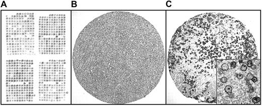 Fig. 1. TMA design. / (A) Distribution of core cylinders in TMAs. Preservation of morphology, antigen preservation, and representativity of these samples is shown in one of these cylinders, corresponding to nodular sclerosis HL, stained for H/E (B) and CD30 (C). Original magnification, panels B-C, × 40; panel C inset, × 600.
