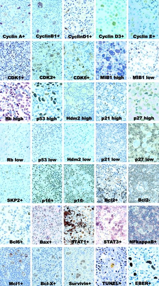 Fig. 2. IHC and ISH patterns. / Samples with positive and negative (or high vs low expression) for each marker are shown. All these cases are representative of classical HL, with either nodular sclerosis or mixed cellularity. Original magnification for cyclins, MIB1, Rb, p53, p27, p65/RelA, Bcl6, TUNEL, and EBER, × 1000; remaining panels, × 600.