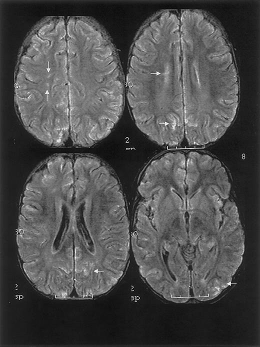 Fig. 1. MRI findings for case 1. / Multifocal areas of fluid-attenuated inversion recovery (FLAIR) T2-weighted signal abnormality in the subcortical white matter and overlying gray matter of the frontal, parietal, and occipital lobes (bottom).