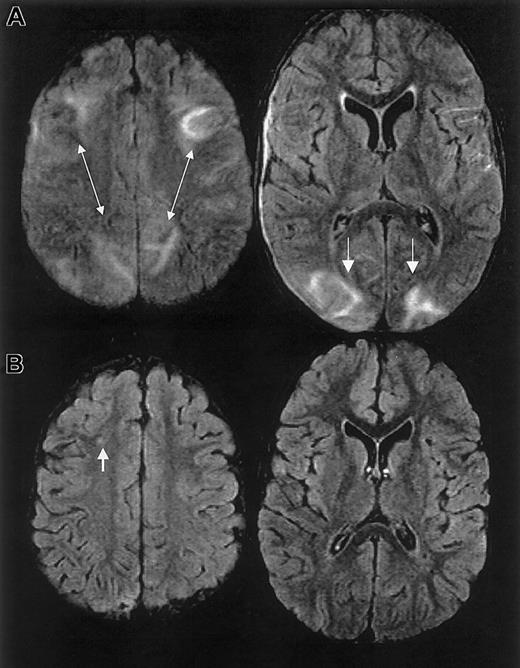 Fig. 2. MRI findings for case 2. / Multifocal areas of signal hyperintensity predominantly limited to the cortex of the posterior parietal and occipital lobes on FLAIR T2-weighted images, including punctate areas of abnormality in the deep, periventricular white matter of the right frontal lobe and of the cortex of the right medial parietal lobe. MRI done 1 month following discharge revealed punctate lesions in the frontal lobe, representing subacute to chronic ischemic changes, but resolution of the T2 hyperintense lesions in the posterior distribution.