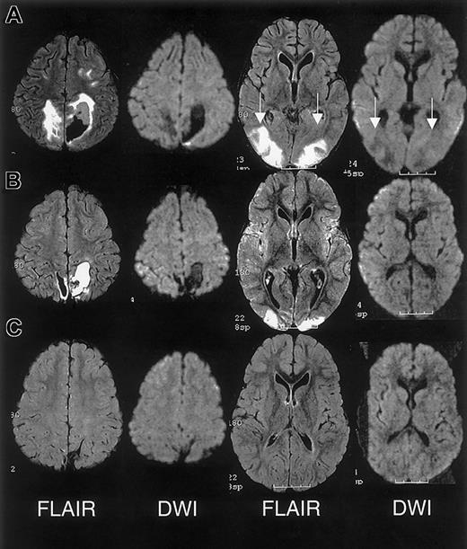 Fig. 3. MRI findings for case 3. / (A) Extensive areas of FLAIR T2-weighted signal hyperintensity in the subcortical white matter and overlying gray matter of the posterior, frontal, and occipital lobes. Parenchymal hemorrhage was seen in the high parietal region predominantly on the patients's left. (B-C) Follow-up MRI scan 1 month and 15 months following discharge showed progressive evolution and resolution of the T2 signal hyperintensities with residual encephalomalacia in the left parietal region. These findings were consistent with reversible posterior leukoencephalopathy complicated by hemorrhage; there was no evidence of infarction.