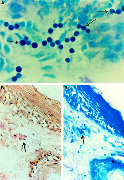 Fig. 1. Photomicrographs of skin biopsy from a patient with acute cutaneous GVHD. / (A) Photomicrograph of adherence assay result showing binding of rat thoracic duct lymphocytes to papillary dermis of skin from patient with acute cutaneous GVHD (methyl green-thionin stain, × 250). The characteristic appearance of arcuate, palisading adherent lymphocytes (dark blue dots) is identified by arrows. This distribution of lymphocytes is typical for binding of cells to underlying vascular structures. (B) Photomicrographs of sequential 8-μm frozen sections of skin biopsy from a patient with acute cutaneous GVHD. Panel Bi shows immunohistochemical stain for CD34 antigen, demonstrating location of endothelial structure. Panel Bii is the adherence assay result, showing PBMCs (blue dots) attaching to dermal papillary structure (methyl green-thionin stain, × 250). Note correlation of CD34 staining with location of adherent lymphocytes (arrows).