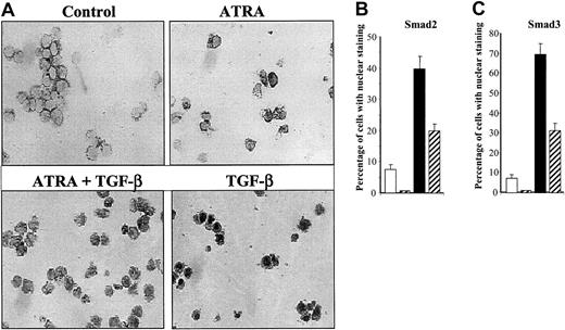 Fig. 3. Immunohistochemical staining of Smad3/Smad2 in HL-60 cells. / (A) Expression of Smad3 as detected by anti-Smad3 antibody in HL-60 cells untreated (white) or treated with 10 nM ATRA (gray striped), with 10 ng/mL TGF-β1 (black), or with both (black and white striped) for 18 hours as described. Original magnification × 200. (B-C) Following immunohistochemical staining, the percentage of cells with Smad2 (B) or Smad3 (C) staining predominantly or exclusively in the nucleus was determined among 1000 cells in 5 different fields. Values are expressed as the means ± SEMs of 3 experiments.