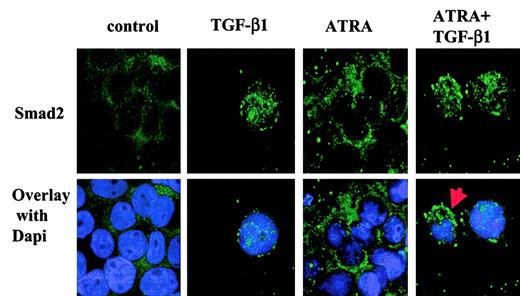 Fig. 4. Localization of endogenous Smad2 in HL-60 cells by confocal microscopy. / After 18-hour incubation with 10 ng/mL TGF-β1, 10 nM ATRA, or both, the cells were fixed, subjected to immunochemistry with primary antibodies against Smad2 and secondary antibodies linked to fluorescein isothiocyanate, and mounted with medium containing 4,6- DAPI. The red arrow indicates that Smad2 is localized both in the nucleus and in the cytoplasm. Original magnification for all panels, × 630. The result is representative of 3 similar experiments.
