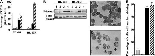 Fig. 8. The effect of RAR-α on the ability of ATRA to decrease levels of phospho-Smad2/Smad3. / The ability of ATRA to decrease levels of phospho-Smad2/Smad3 is dependent on RAR-α. (A) Treatment for 4 days with ATRA together with TGF-β1 enhances the expression of CD14 by HL-60R compared with cells treated with TGF-β1 alone (means ± SEMs). (B) In contrast to wild-type HL-60, ATRA is unable to reduce levels of phospho-Smad2 induced by TGF-β1 in RAR-α–mutant HL-60 cells (HL-60R) treated simultaneously with ATRA and TGF-β1 (lane 3 compared with lane 4). Treatments were for 24 hours. (C-E) Immunohistochemical staining showed that ATRA is unable to reduce the TGF-β1–dependent Smad3 nuclear localization in RAR-α–mutant HL-60 cells treated for 18 hours with ATRA and TGF-β1 (C) as seen in wild-type HL-60 cells (D). Original magnification × 400. The arrow on the left shows a cell with both nuclear and cytoplasmic staining, and the arrow on the right shows a cell with only cytoplasmic staining. (E) Quantitation of the data in panel C was obtained by assessment of the staining patterns in 1000 cells in 5 different fields of treated HL-60R cells. For panels A, B, and E, treatments were (1) vehicle (gray); (2) ATRA, 10 nM (black and gray striped); (3) TGF-β1, 10 ng/mL (black); or (4) the combination of ATRA and TGF-β1 (black and white striped).