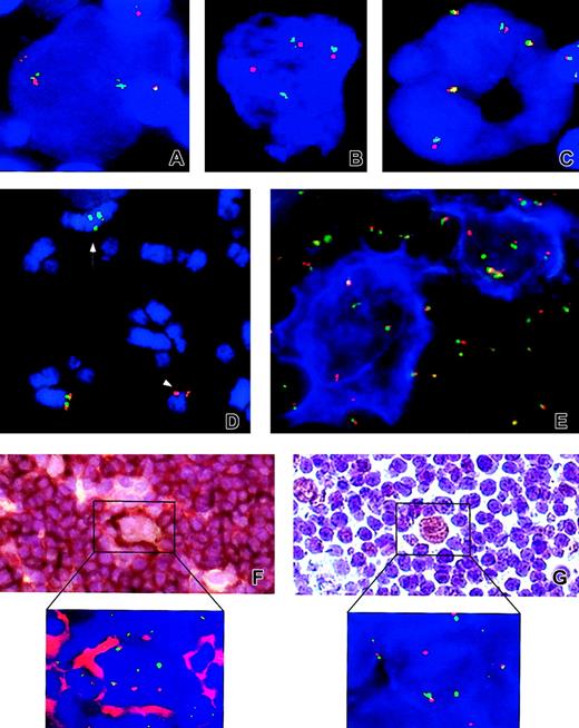 Fig. 1. Examples of FISH and IHC results. / Analyzed cases: NLPHL cases no. 4 (A), no. 13 (B,E), no. 2 (D), no. 3 (F and inset), and no. 1 (G and inset) and classical HL case no. 24 (C). Applied probes: LSI BCL6 (A-E, F inset, G inset). (D) Arrow and arrowhead indicate the der(3) t(3;7;3;1) and the der(7)t(3;7) chromosomes, respectively. (E) An example of FICTION with CD20 (blue) and LSI BCL6 (F-G and insets of both panels). Examples of sequential IHC and FISH with CD20 and LSIBCL6, and anti-BCL6 and LSI BCL6, respectively. Note the split of LSI BCL6 signals in atypical cells from NLPHL cases (A-E,F inset, and G inset) and presence of only fused signals in the cHL case (C). Original magnifications × 630 (A-C,E), × 400 (F-G), and × 1000 (F-G insets).