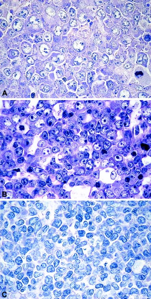 Fig. 1. The morphologic spectrum of CD5+DLBLs. / (A) DLBL centroblastic. (B) DLBL immunoblastic. (C) DLBL unclassified. Giemsa stain, original magnifications × 400.