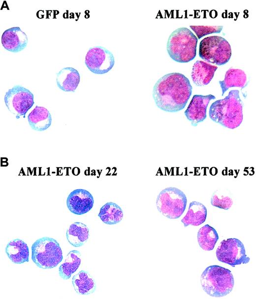 Fig. 4. Morphology of AML1-ETO–transduced cells cultured in IL-3, IL-6, and SCF. / Representative cytocentrifuge preparations stained with Wright-Giemsa. (A) Comparison of control (GFP, left) and AML1-ETO–transduced (right) cultures at day 8. (B) AML1-ETO–transduced cells at day 22 (left) and 53 (right). Original magnification × 400.