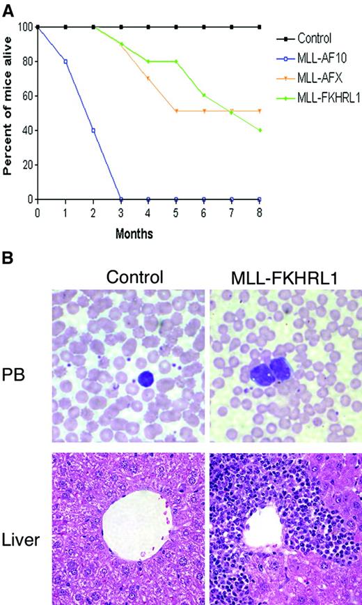 Fig. 2. MLL-FKHRL1–immortalized cells induce acute leukemias with latencies similar to MLL-AFX. / (A) Survival curves are shown for cohorts (n = 10) of sublethally irradiated C57BL/6 mice that were injected with MLL-FKHRL1–, MLL-AFX–, or MLL-AF10–immortalized cells or saline injected (control) mice. Differences in survival were statistically significant for MLL-FKHRL1 compared to control (P < .018) and MLL-AF10 (P < .008) cohorts but not for MLL-AFX cohort (P < .299). (B) Representative histology is shown for control and MLL-FKHRL1 mice. Leukemic blasts are present in the peripheral blood and infiltrate the portal veins of liver of moribund MLL-FKHRL1 mice (original magnification, × 400). Blood smears were stained with May-Grünwald-Giemsa; paraffin sections were stained with hematoxylin and eosin (original magnification, × 200).