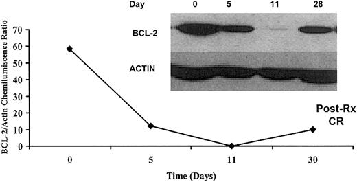 Fig. 4. Bcl-2 protein quantification by immunoblotting. / Bcl-2 levels in UPN 1 before treatment and at days 5 (prior to FLAG), 11 (at completion of G3139 and FLAG treatment), and 28 (at time of neutrophil and platelet count recovery) are shown. This patient achieved a complete response to G3139 and FLAG (Table 5).