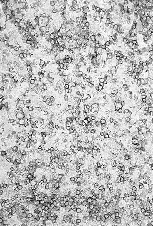 Fig. 1. CD20+ tissue sample. / Photomicrograph of a histologic slide of a cervical lymph node infiltrated by a nodular/diffuse paragranuloma (lymphocyte predominant Hodgkin disease) confirmed by the pathology reference panel of the GHSG. Immunoperoxidase staining for L26 (CD20); original magnification, × 100.