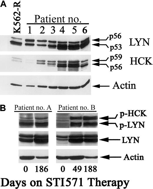 Fig. 10. Expression and activation of LYN and HCK kinases in STI571-resistant CML patients. / (A) Cell lysates were prepared from K562-R cells and specimens derived from several patients who failed to sustain hematologic remission with STI571 daily therapy (400-600 mg). Equal protein aliquots (20 μg) were resolved by SDS-PAGE, transferred to nitrocellulose membranes, and immunoblotted for LYN or HCK with specific primary antibodies as described in “Materials and methods.” Actin levels on the same blot were used to determine protein equivalence in each sample. (B) Blood samples were collected from blast-crisis CML patients one day prior to beginning STI571 daily therapy (day 0) and at 1 or 2 points after disease progression (as noted). Specimens were prepared (as described in “Materials and methods”), protein content was estimated, and equal protein extracts were resolved by SDS-PAGE and immunoblotted with antibodies recognizing phosphorylated LYN (or HCK; p-HCK, p-LYN). The blot was stripped of primary antibody and reprobed with anti-LYN. Actin also was probed to determine protein equivalence in each sample.