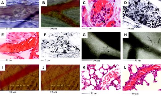 Fig. 2. Features of the reaction induced by 4 hours of TNF-α followed by RB6-8C5. / (A-B) Leukocytes adhere and form aggregates in venules (A) and arterioles (B). (C-D) Aggregates are comprised of neutrophils (marked N in panels C and D), platelets (marked P in panel D), and monocytes (marked M in panel D). (E) Plasma clots develop in obstructed vessels; pale pink areas suggest platelets and fibrin. (F) Intravascular fibrin deposition. Black electron dense fibrin strands are clearly evident. Section runs through a compartment that also contains RBCs (not shown). (G-H) Injected fluorescent albumin remains vessel bound after TNF-α (G), but rapidly leaks into tissues if RB6-8C5 is applied (H). (I-J) Arteriolar vasoconstriction is detected soon after RB6-8C5. Panel K shows a lung section from a mouse stimulated with TNFα (50 ng, intrascrotal). Alveolar capillaries appear congested and contain inflammatory cells, but the large vessel to the right remains open. Panel L shows a lung section from a TNFα-stimulated mouse subsequently treated with RB6-8C5. The large vessel running diagonally across the image is extremely congested.