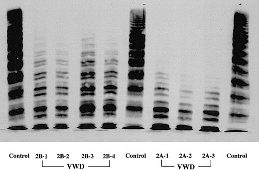 Fig. 1. Multimer patterns of plasma VWF in VWD patients. / SDS–1.5% agarose gel electrophoresis was performed in all VWD patients studied in this work. Three type 2A VWD patients completely lack the larger and intermediate VWF multimers in plasma. Compared with type 2A patients, the lack of larger VWF multimers in all type 2B patients was less severe, with intermediate forms retained.