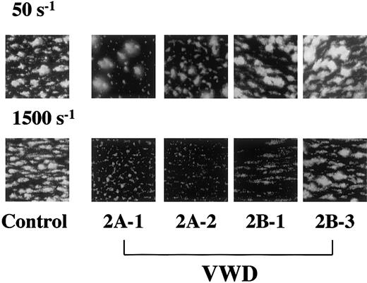 Fig. 2. Thrombus generation on a collagen surface in a healthy control and type 2A and 2B VWD patients at a typical low or high shear rate. / Whole blood containing mepacrine-labeled platelets was perfused through a collagen-coated glass surface at a low (50 s−1) or high (1500 s−1) shear rate condition. Images, displayed as accumulated mepacrine fluorescence, were obtained at 7 minutes after the beginning of platelet-surface interaction during perfusion. Two patients were selected as representative of each VWD subtype (Tables 1and 2), and control images (control-2 in Table 2) are representative of 5 independent perfusions using blood from 5 individual donors (original magnifications × 400). At a low shear rate, platelet thrombi in all VWD patients were generated to an extent comparable to that in healthy controls. In contrast, thrombus generation in type 2A patients was apparently reduced compared with a healthy control at a high shear rate. The extent of thrombus generation in type 2B patients under high shear was heterogeneous, ranging from normal to significantly reduced (Table 2).