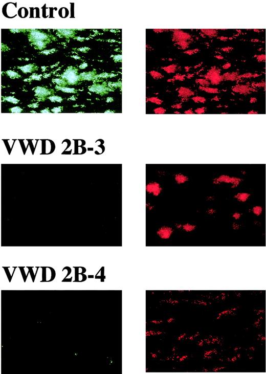 Fig. 5. Distribution of VWF and fibrinogen in thrombi generated under a high shear rate. / Whole blood, without mepacrine labeling, from a healthy control or type 2B VWD patients (2B-3, -4) was perfused over a collagen surface at a high shear rate (1500 s−1 thrombi generated at 7 minutes of perfusion were fixed, double-stained with Cy2-labeled anti-VWF and Cy3-labeled antifibrinogen antibodies, and viewed by CLSM. The images displayed are cross-sections at a height of 15 μm from the collagen surface (original magnifications × 400) and are representative of 2 independent perfusions of blood from a control or patient, respectively. Unlike control thrombi, VWF is poorly stained (green, left panels), compared with fibrinogen (orange, right panels), in type 2B VWD thrombi.