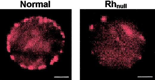 Fig. 1. Equatorial sections of normal and Rhnullerythrocytes labeled for CD47 with phycoerythrin-tagged monoclonal antibody BRIC126 (PhE-BRIC126). / Spots on the membrane of these osmotically sphered cells are the result of both the size and the intensity of the antibody probe and the production of clusters of cross-linked CD47. Rhnull cells labeled with the same concentration of probe clearly exhibit a lower overall fluorescence intensity as well as a decrease in the number of clusters on the cell. The bar in each image represents 2 μm.