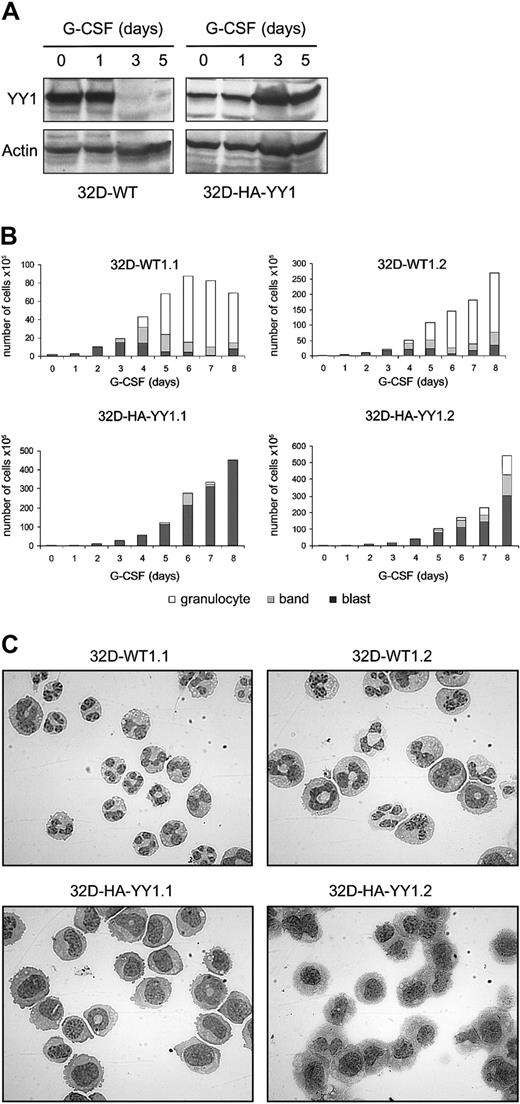 Fig. 4. Ectopic expression of HA-YY1 in 32D cells inhibits neutrophilic differentiation. / (A) Western blot analysis with anti-YY1 in 32D-WT1 and with anti-HA antibodies in 32D-HA-YY1 cells after switching the cells from IL-3– to G-CSF–containing medium on t = 0 days. The blot was reprobed with anti-actin antibodies for loading control. (B) Differential cell count (blasts, band form, and segmented nuclei) of 2 representative 32D-WT1 and 2 representative 32D-HA-YY1 clones. (C) Micrographs showing morphology of 32D-WT1 and 32D-HA-YY1 clones on day 5 (original magnification, × 1000).