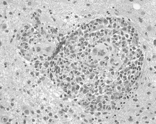 Fig. 1. Histopathology of PCNSL. / Brain biopsy specimen from a patient with PCNSL shows infiltration of brain tissue by large malignant lymphocytes, with characteristic perivascular collections of tumor cells (hematoxylin and eosin, original magnification × 400).