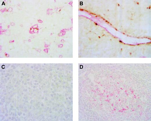 Fig. 3. BCA-1 is expressed by B lymphocytes and vascular endothelium in PNCSL. / Double immunostaining confirms expression of BCA-1 by CD20+B cells in panel A (DAB, BCA-1; Fast Red, CD20; no counterstain, original magnification × 1000) and CD31+ vascular endothelium in panel B (DAB, BCA-1; Fast Red, CD31; no counterstain, original magnification × 1000). Brain biopsy specimen from a patient with PCNSL does not contain CD21+ cells (C), whereas, in panel D, CD21+ cells are detected in a lymphoid follicle of a normal tonsil (Fast Red, hematoxylin counterstain, original magnification × 600).