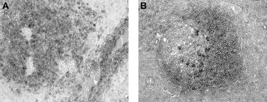 Fig. 4. CXCR5 expression in tonsil and PCNSL. / (A) Immunohistochemical examination of brain biopsy specimen from a patient with PCNSL demonstrates expression of CXCR5 by cells of perivascular malignant infiltrates (BCIP/NBT, no counterstain, original magnification × 400). (B) Normal tonsil shows CXCR5-expressing cells in lymphoid follicles, particularly in the mantle zone (BCIP/NBT, no counterstain, original magnification × 400).